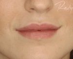 Injectare Acid Hyaluronic After