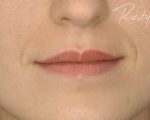 Injectare Acid Hyaluronic Before