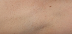 Epilare definitiva laser After
