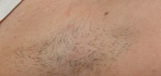 Epilare definitiva laser Before