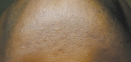Epilare definitiva laser After