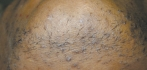 Epilare definitiva laser Before