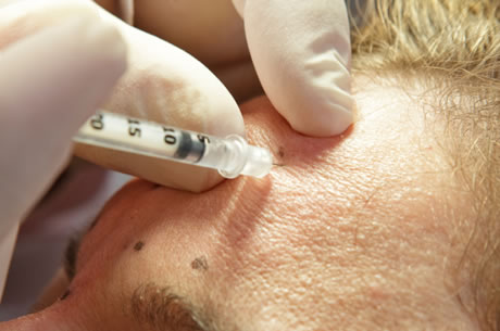 Injectare botox