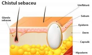 Chist sebaceu / furuncul