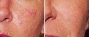 rosacea-before-and-after