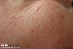 cicatrici-acnee-dermestetica-tratament