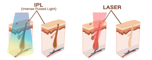 Epilare-laser-vs-epilare-ipl-dermesteticaepilare-laser-vs-epilare-ipl-dermestetica