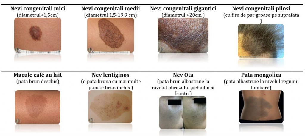 tipuri-de-alunite-congenitale