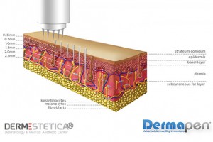 dermapen-microneedling