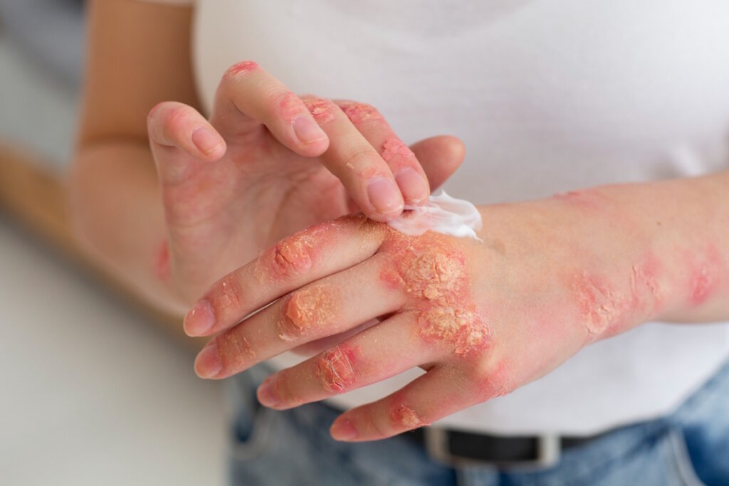 Pacient care aplica crema tratament pentru psoriazis